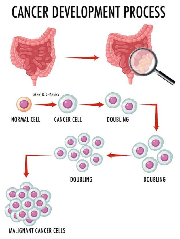 are anal polyps cancerous