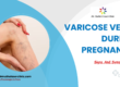 varicose Veins During Pregnancy