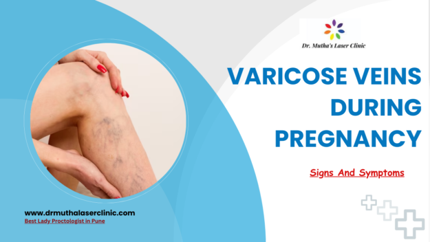 varicose veins during pregnancy treatment pune varicose Veins During Pregnancy