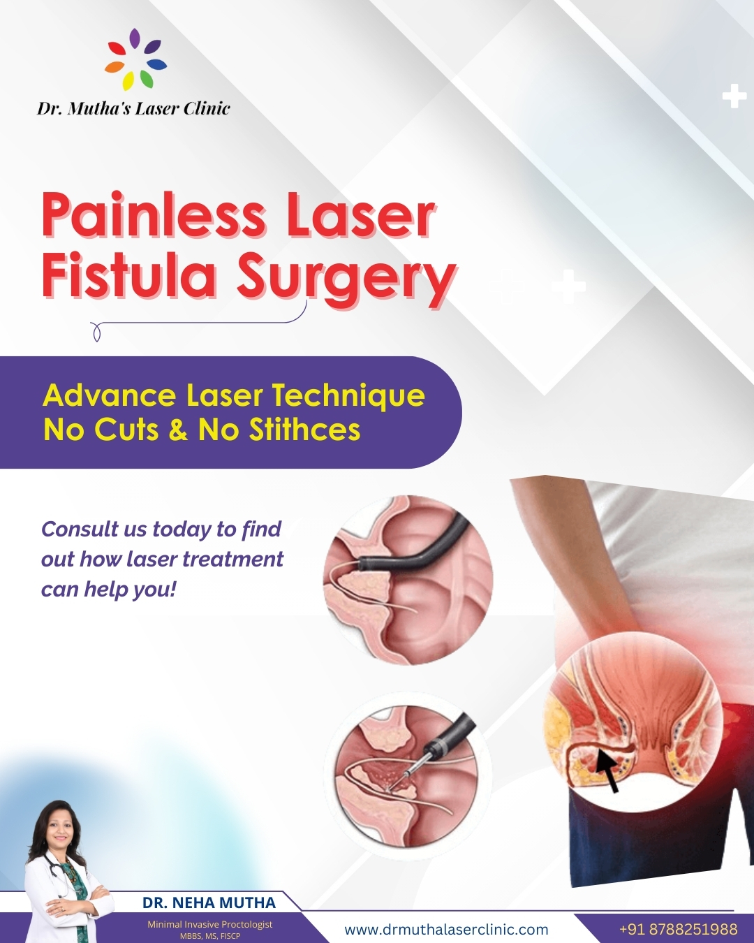 Fistula Treatment in Pune