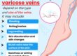 Varicose Veins Treatment in Pune