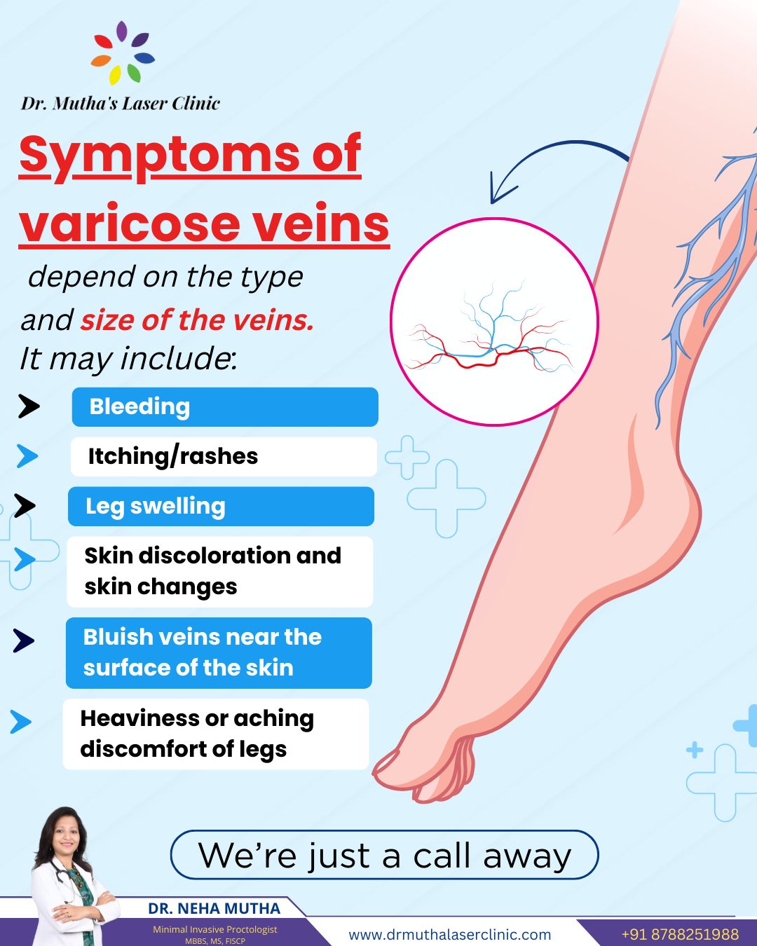 Varicose Veins Treatment in Pune