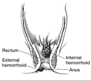hemorrhoids piles in anal region – piles specialist in Pune