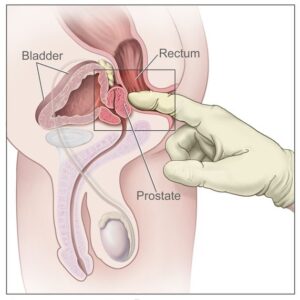 Doctor diagnosing anal fissure or fistula using physical examination and anoscopy