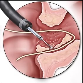 Treatment options for anal fissure including medicines, sitz bath, and laser surgery
