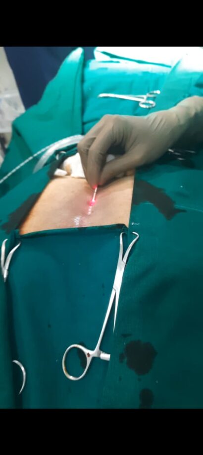 Pilonidal sinus surgery performed by Dr. Neha Mutha, Pilonidal Sinus Specialist in Pune using advanced minimally invasive laser treatment.