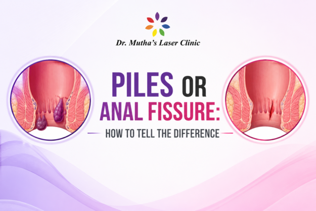 Piles or Anal Fissure: understanding the key differences between common anorectal conditions
