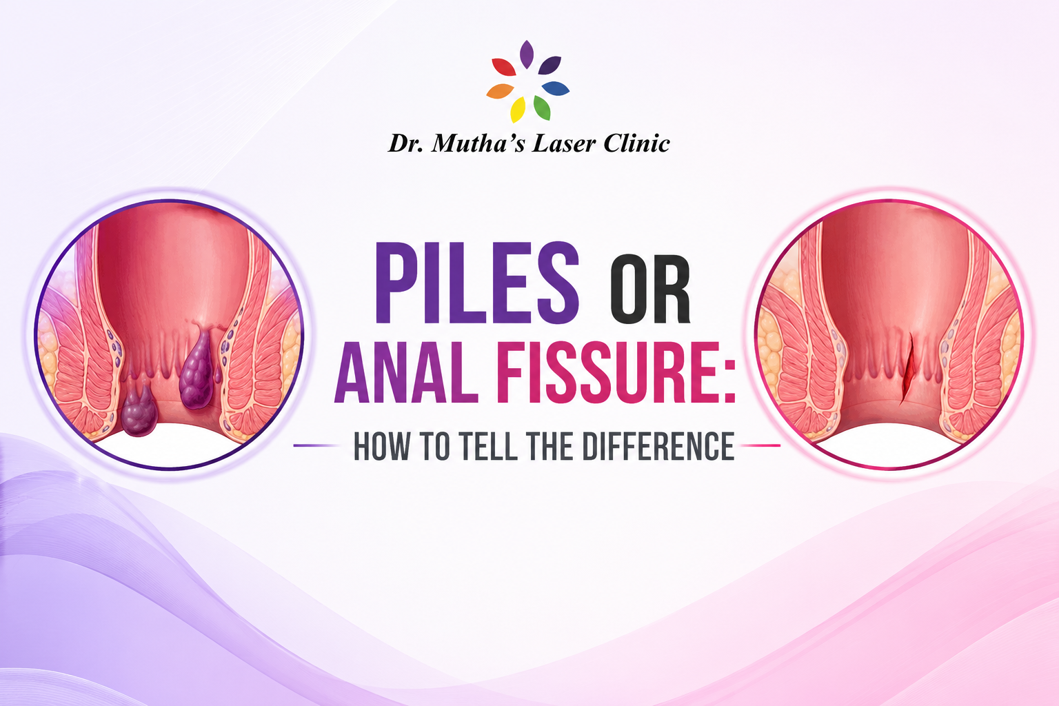 Piles or Anal Fissure: understanding the key differences between common anorectal conditions