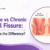 Acute vs chronic anal fissure comparison
