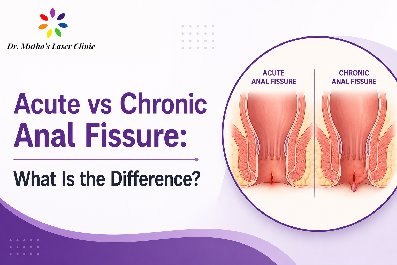 Acute vs chronic anal fissure comparison