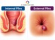 Internal vs external piles differences explained by Dr. Neha Mutha