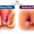 Internal vs external piles differences explained by Dr. Neha Mutha